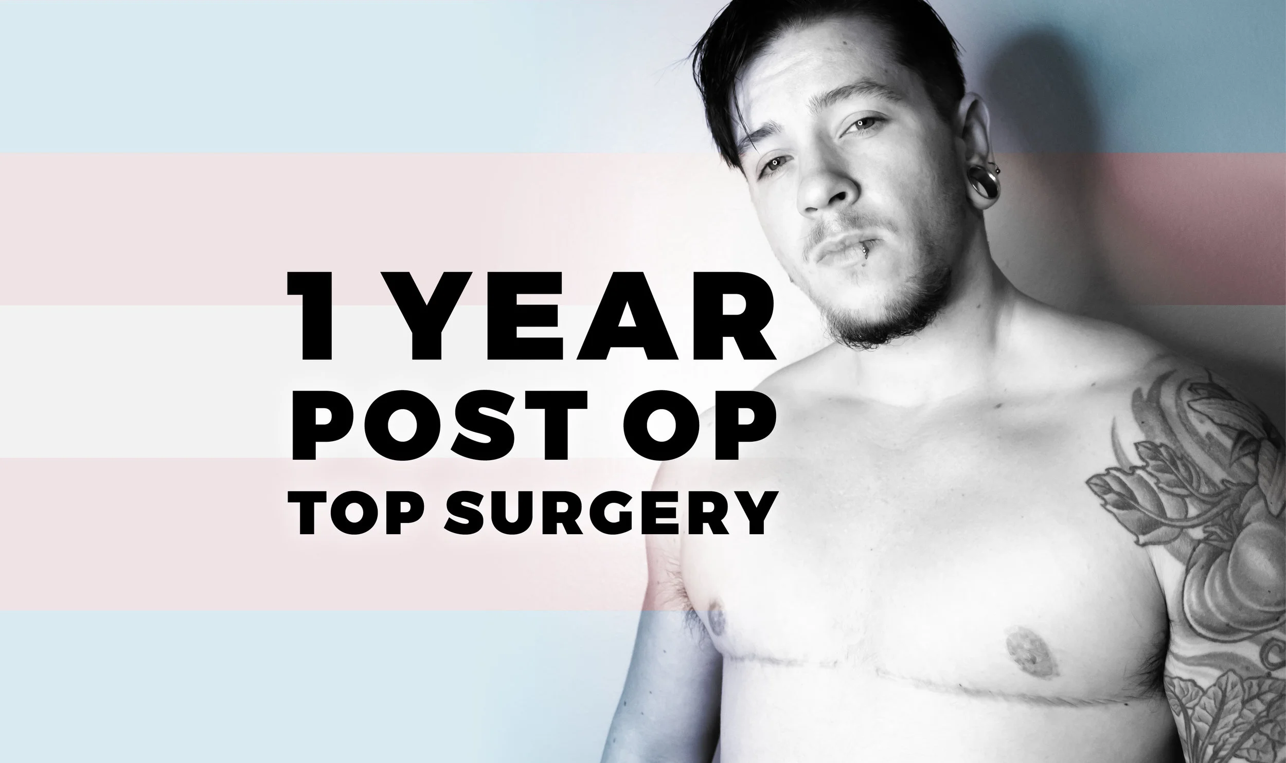 One Year Post Op Top Surgery - Review of Dr. Garramone and Results
