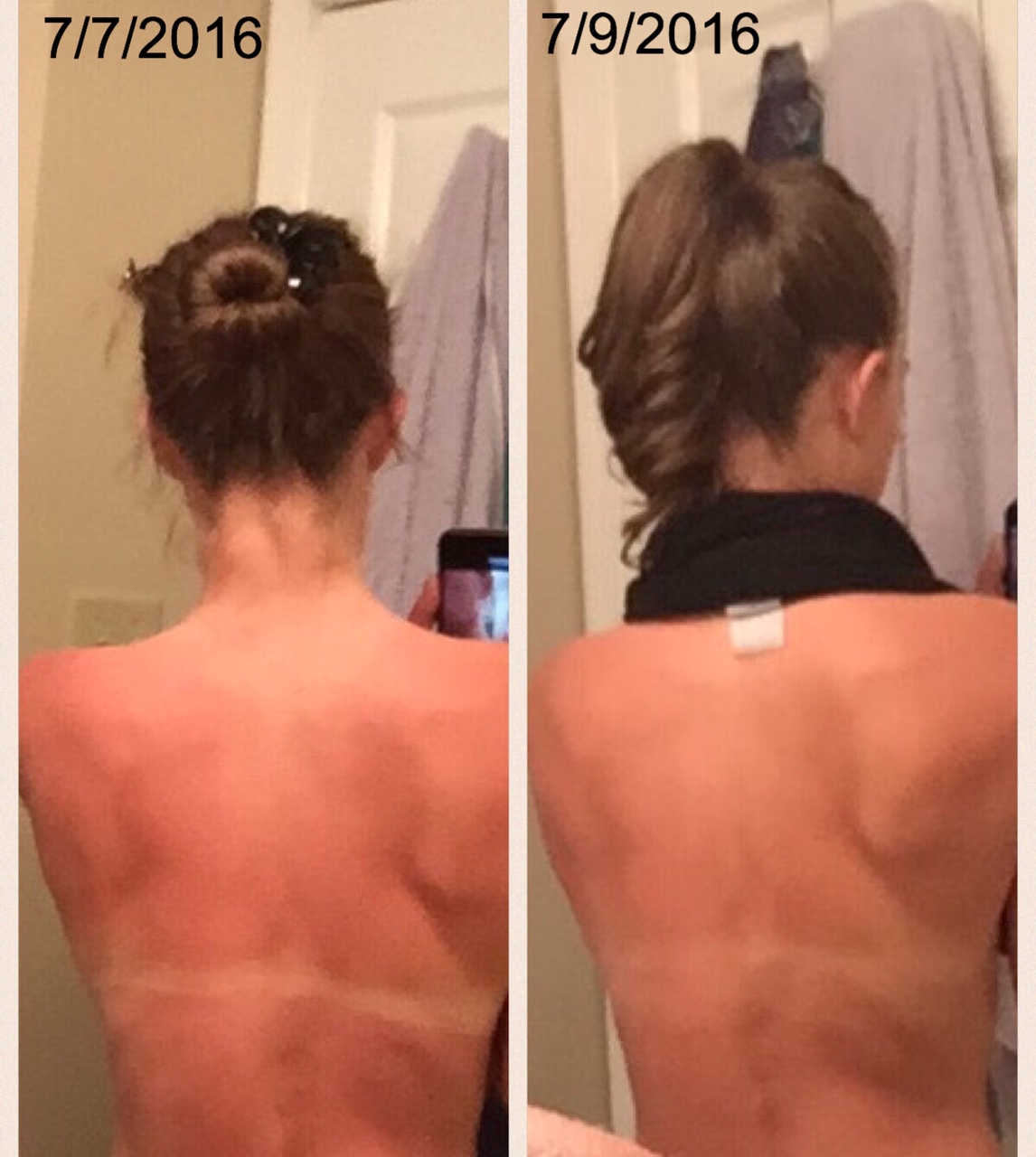Can You Use Apple Cider Vinegar For Sunburn?  