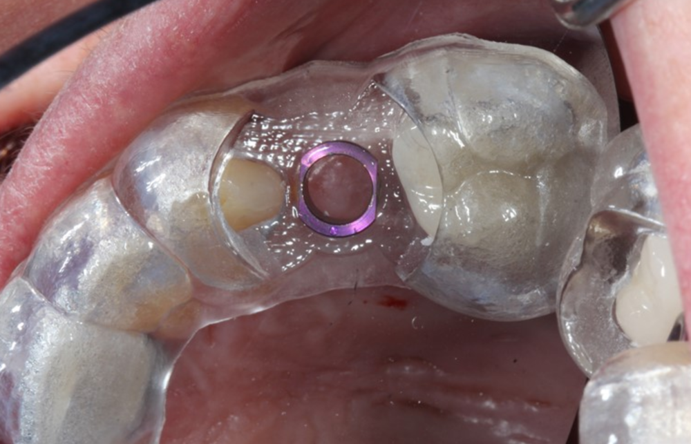 3D Implant Plan & Place