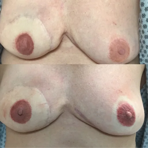 Before and After