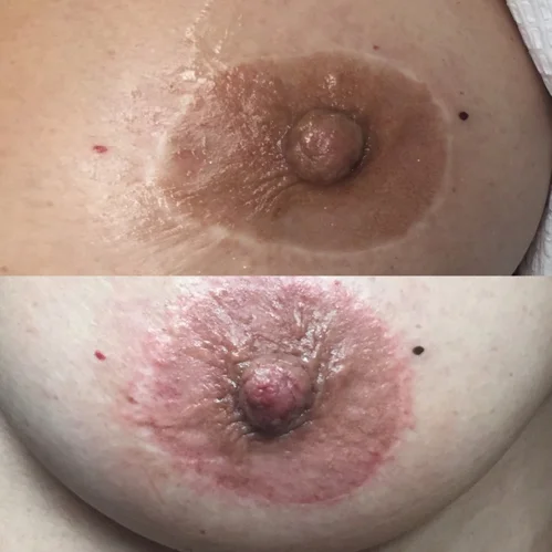 Before and After