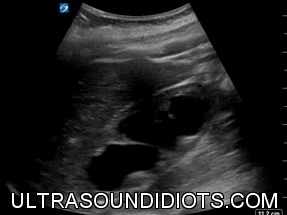 Right Kidney and Liver, Severe Hydronephrosis.