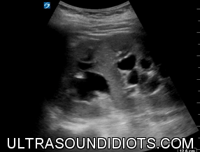Left Kidney, Moderate Hydronephrosis