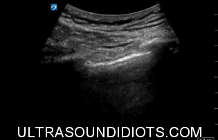 Pleural Exam 17
