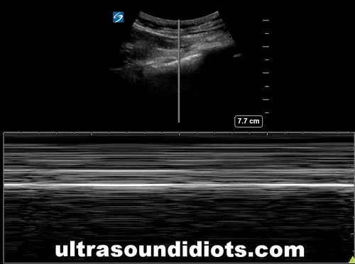 Pleural Exam 18