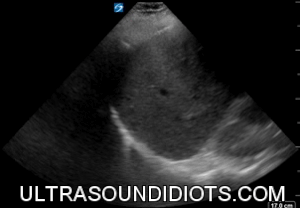 RUQ Exam 2 - Negative Exam. This is an excellent clip which clearly shows all four areas of interest- the pleural space, the subphrenic space (between diaphragm and liver), the hepatorenal space (Morrison’s pouch), and the inferior pole of the kidney.