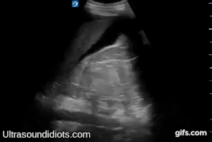 RUQ Exam 4 - Positive Exam, Limited View. Free Fluid located within Morrison's pouch and inferior pole of right kidney. The pleural space and subphrenic space are not visualized.