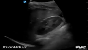 RUQ Exam 5 - Positive Exam, Limited View. Free fluid located within Morrison's pouch. The pleural space, the subphrenic space and the inferior pole of the right kidney are not visualized.