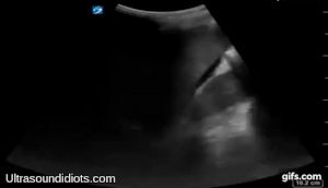 RUQ Exam 7 - Positive Exam, Limited View. Free fluid located within Morrison's pouch. The pleural space, the subphrenic space and the inferior pole of the right kidney are not visualized.