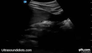 RUQ Exam 9 - Positive Exam, Limited View. This exam is tricky. The gallbladder is present at the beginning of the clip and should not be confused with free fluid. Close inspection of the later part of the clip shows free fluid below the inferior pole of the kidney. The the pleural space, the subphrenic space (between diaphragm and liver), and the hepatorenal space (Morrison’s pouch) are not visualized in the clip.