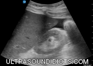 RUQ Exam 11 - Positive Exam, Limited View. Free fluid located below the inferior pole of the right kidney. The the pleural space and the subphrenic space are not visualized in the clip. Note that there is no fluid present in Morrison's pouch.