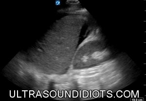 RUQ Exam 12 - Positive Exam, Limited View. Free fluid located within Morrison's pouch. This was a delayed presentation, 2 days after injury. Note the hyperechoic tissue (clot) in Morrison's pouch. The pleural space, the subphrenic space and the inferior pole of the right kidney are not visualized.