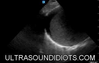 RUQ Exam 13 - Positive Exam, Limited View. Free fluid located in the subphrenic space. There is not fluid in the pleural space. Morrison's pouch and the inferior pole of the right kidney are not viewed.