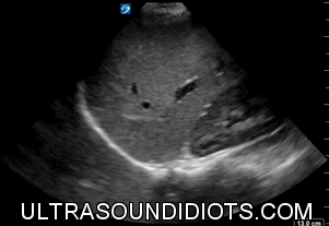 RUQ Exam 14 - Negative Exam. This is an excellent clip which clearly shows all four areas of interest- the pleural space, the subphrenic space (between diaphragm and liver), the hepatorenal space (Morrison’s pouch), and the inferior pole of the kidney.