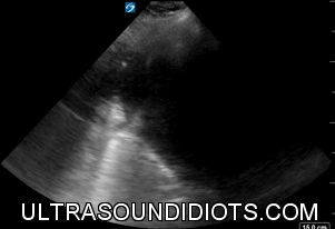 RUQ Exam 15 - Positive Exam, Complete View. There is no fluid in the pleural space. Free fluid located in the subphrenic space. The hepatorenal space and the inferior pole of the right kidney demonstrate no free fluid.