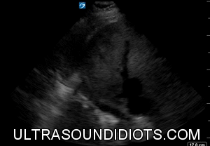 RUQ Exam 16 - Positive Exam, Limited View. There is a small amount of fluid in the pleural space. The subphrenic space demonstrates no free fluid. Morrison’s pouch and the inferior pole of the right kidney are not visualized.