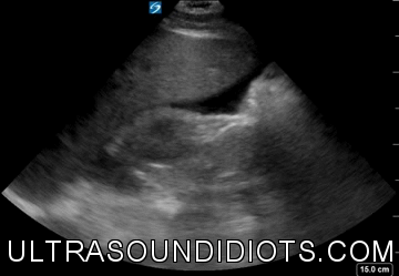 RUQ Exam 18 - Positive Exam, Limited View. The pleural space and the subphrenic space are not visualized. There is fluid in Morrison’s pouch and the inferior pole of the right kidney.