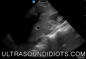 RUQ Exam 19 - Negative Exam. This is an excellent clip which clearly shows all four areas of interest- the pleural space, the subphrenic space, the hepatorenal space, and the inferior pole of the kidney.