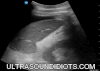 LUQ Exam 2 - Positive Exam, Limited View. The pleural space is not visualized. The subphrenic space has free fluid. There is no fluid in the splenorenal space. The inferior pole of the left kidney is not visualized.