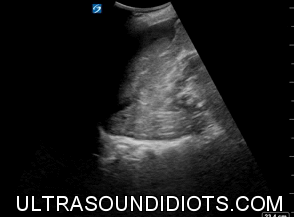 LUQ Exam 3 - Positive Exam, Limited View. The pleural space is not visualized. The subphrenic space has free fluid. There is no fluid in the splenorenal space. The inferior pole of the left kidney is not visualized.