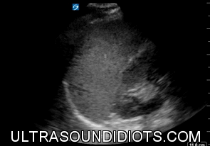LUQ Exam 4 - Negative Exam. This is an excellent clip which clearly shows all four areas of interest- the pleural space, the subphrenic space (between diaphragm and spleen), the splenorenal space, and the inferior pole of the left kidney.