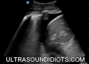 LUQ Exam 5 - Positive Exam, Limited View. Free fluid located within the pleural space consistent with hemothorax in the setting of trauma. The subphrenic space, the splenorenal space and the inferior pole of the left kidney are not visualized.