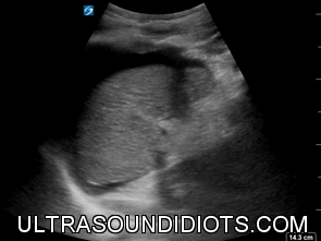 LUQ Exam 6 - Positive Exam, Limited View. The pleural space is not visualized. The subphrenic space has free fluid. The splenorenal space and the inferior pole of the left kidney are not visualized.
