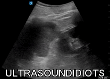 LUQ Exam 8 - Positive Exam, Limited View. The pleural space is not visualized. The subphrenic space has free fluid. There is no fluid in the splenorenal space. The inferior pole of the left kidney is not visualized.