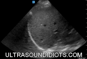 LUQ Exam 9 - Negative Exam. This is an excellent clip which clearly shows all four areas of interest- the pleural space, the subphrenic space (between diaphragm and spleen), the splenorenal space, and the inferior pole of the left kidney.