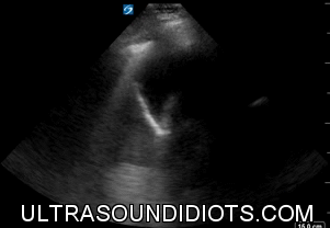 LUQ Exam 11 - Positive Exam, Complete View. There is no fluid in the pleural space. The subphrenic space has free fluid. There is no fluid in the splenorenal space or the inferior pole of the left kidney.