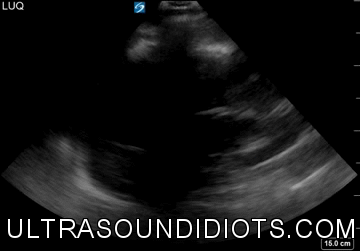 LUQ Exam 12 - Positive Exam, Limited View. The pleural space is not visualized. The subphrenic space is not clear and there does not appear to be free fluid in this space. There is free fluid at the superior pole of the left kidney consistent with fluid in the splenorenal space. The inferior pole of the left kidney is not visualized.