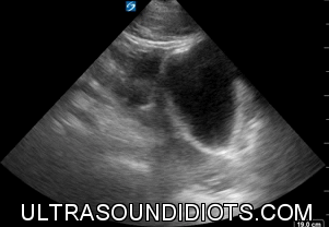 Pelvic Exam 2 - Positive Exam. Sagittal view of the fundus with a small amount of free fluid superior and posterior to the bladder (in the peritoneum).