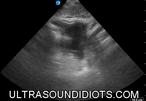 Pelvic Exam 3 - Positive Exam. Limited View. Transverse view of the fundus with free fluid superiorly (in the peritoneum).