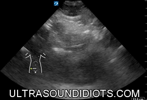 Pelvic Exam 4 - Negative Exam. Transverse view of the bladder fundus with no superior or surrounding free fluid.