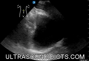 Pelvic Exam 5 - Negative Exam, Limited. Sagittal view of the bladder fundus with no surrounding free fluid seen. This is not a complete study. It is a 3 second clip without clearly showing both sides of the bladder.