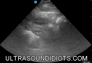Pelvic Exam 8 - Negative Exam. Transverse view of the bladder fundus with no surrounding free fluid seen.