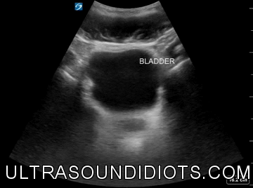 Pelvic Exam 10 - Positive Exam. Transverse view. There is fluid superior to the bladder findus.