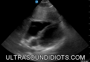 Pericardial Exam 1 - Negative exam. No free fluid visualized within the pericardium.