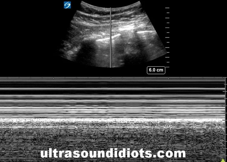 Pleural Exam 4 - Negative for pneumothorax in this view. Unilateral m-mode view of pleural sliding with curvilinear probe.