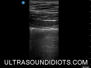 Pleural Exam 5 - Negative for pneumothorax in this view. Unilateral b-mode view of pleural sliding with linear probe. 