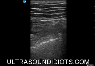 Pleural Exam 6 - Positive Exam. Unilateral B-mode view demonstrating absence of pleural sliding, consistent with pneumothorax.