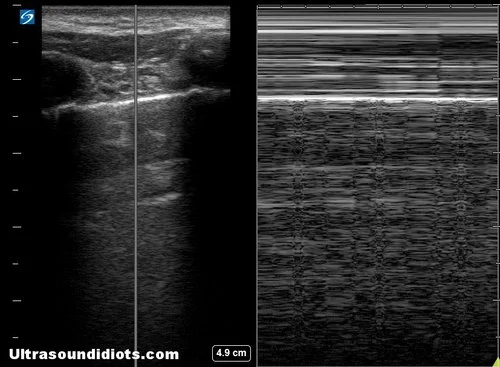 Pleural Exam 7 - Negative for pneumothorax in this view. Unilateral m-mode view of pleural sliding with linear probe.