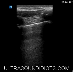 Pleural Exam 8 - Negative for pneumothorax in this view. Unilateral b-mode view of pleural sliding with linear probe. 