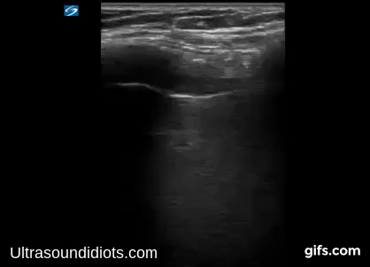 Pleural Exam 9 - Positive Exam. Unilateral B-mode view demonstrating absence of pleural sliding, consistent with pneumothorax.