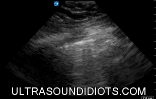 Pleural Exam 13 - Positive Exam. Sector probe. Unilateral B-mode view demonstrating absence of pleural sliding, consistent with pneumothorax.