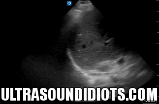 RUQ Exam 20 - Negative Exam. This is an excellent clip which clearly shows all four areas of interest- the pleural space, the subphrenic space, the hepatorenal space, and the inferior pole of the kidney.
