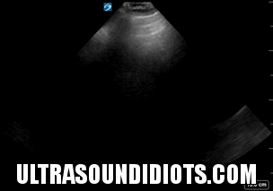 RUQ Exam 21 - LUQ Exam 14 - Negative Exam. This is an excellent clip which clearly shows all four areas of interest- the pleural space, the subphrenic space (between diaphragm and spleen), the splenorenal space, and the inferior pole of the left kidney.