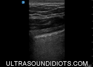Pleural Exam 19