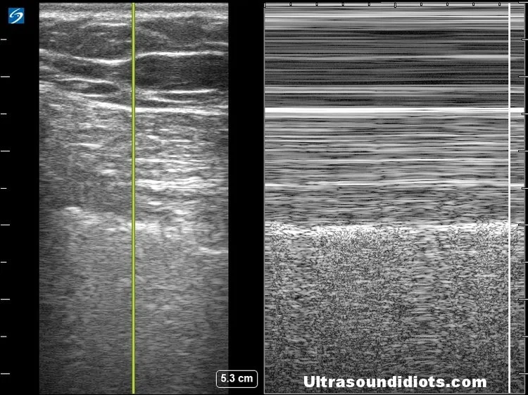 Pleural Exam 20 - Negative for pneumothorax in this view. Unilateral m-mode view of pleural sliding with linear probe.