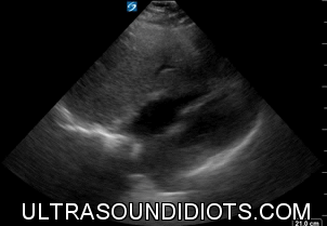 Pericardial Exam 4